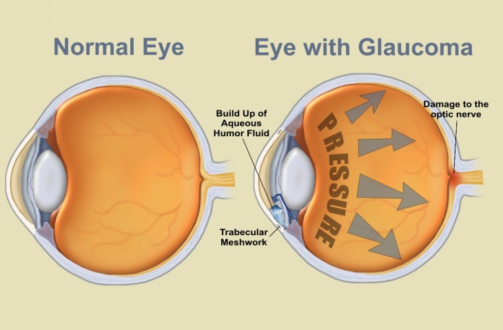 Glaucoma Ayurvedic Natural Herbal Remedies