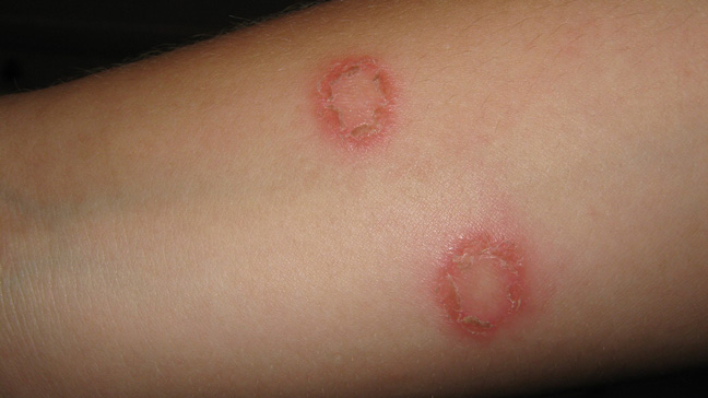 Ringworm treatment, causes, symptoms and risk factors