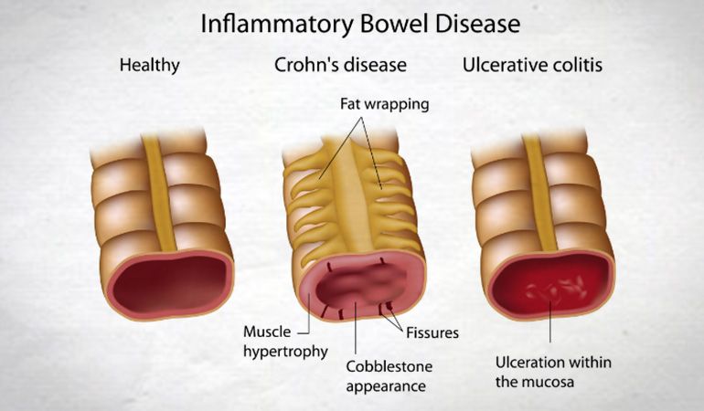 Ulcerative Colitis and Crohns Disease Natural Ayurvedic Treatment