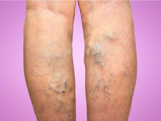 Varicose veins Ayurvedic Herbal Remedies