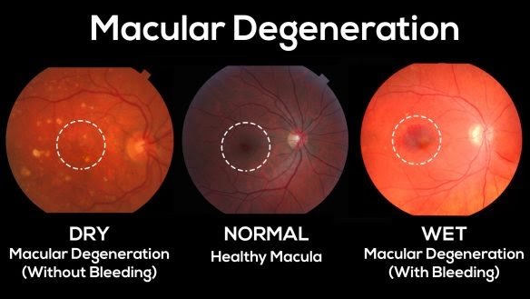 macular edema treatment natural
