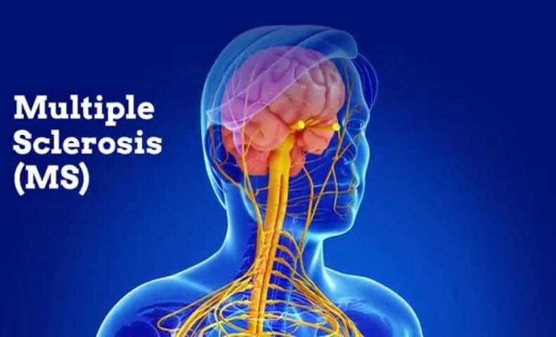 Multiple Sclerosis MS Ayurvedic Herbal Treatment