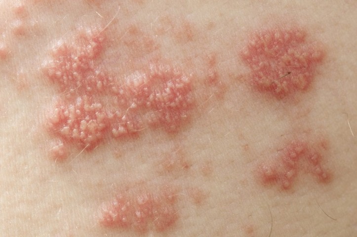Shingles or Herpes Zoster Ayurvedic Natural Treatment
