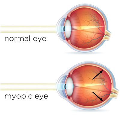 Myopia or Near-sightedness Ayurvedic Herbal Treatment