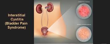 Interstitial Cystitis (IC) Painful Bladder Syndrome Herbal Treatment