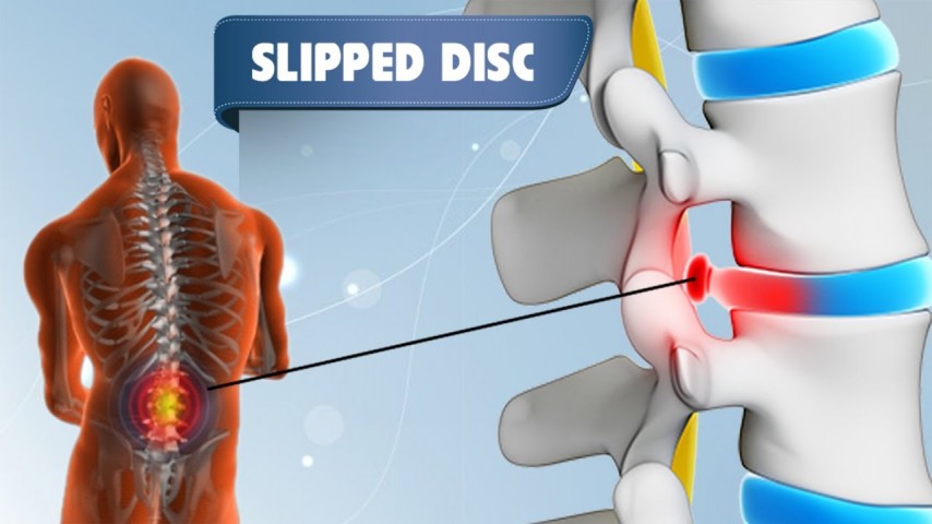 Slipped Disc Herniated Disc Ayurvedic Herbal Alternative Treatment