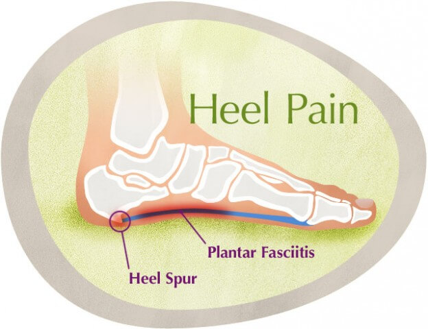 Heel Pain Ayurvedic Herbal Treatment