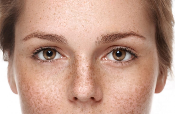 Freckles, Melasma and other Hyper pigmentation problems Ayurvedic Treatment