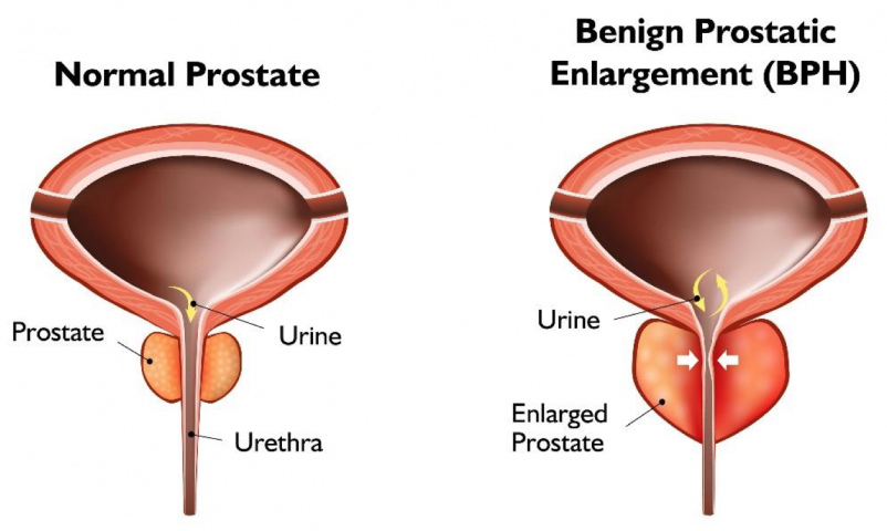 treatment of prostatitis in ayurveda