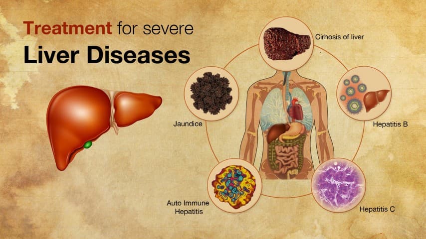 Liver Disorders Ayurvedic Herbal Treatment